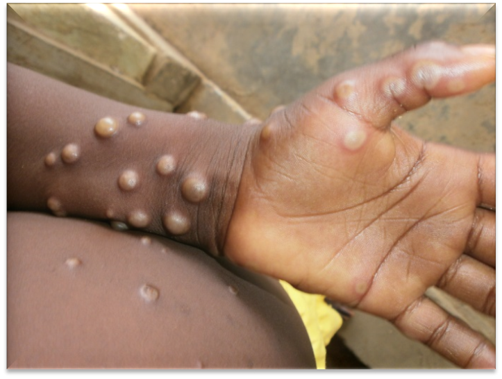 Kano, Seven Other States Put On High Alert As Nigeria Records 39 Cases Of Monkeypox MONKEYPOX
