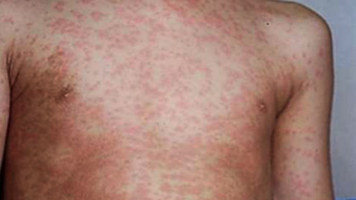 Suspected Measles Outbreak Claims 10 Lives In Abuja Measles patient