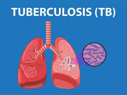 How Tuberculosis Claims 1,869 Lives In Kwara State TB