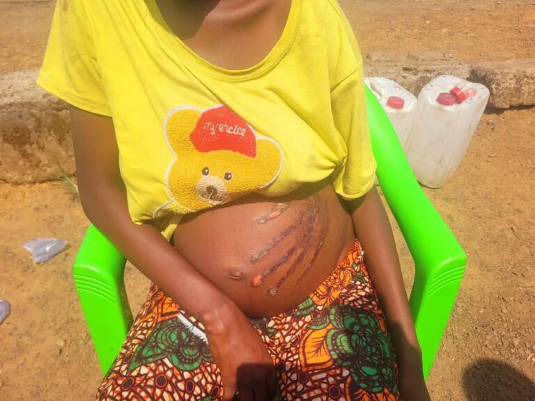 Bizzare: Pregnant Woman Wakes Up To Strange Handprint On Her Stomach b1 1738258611