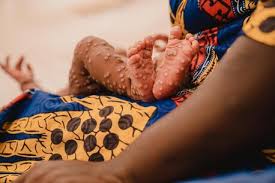 mpox1 mpox1
